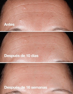 CL SMRT ANTIEDAD CLNC RPR WRKL CRCTN 50M