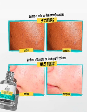 Sérum antiacné facial Truly Targeted Acne-Clearing Pimple Patch with Salicylic Acid Kiehl's todo tipo de piel
