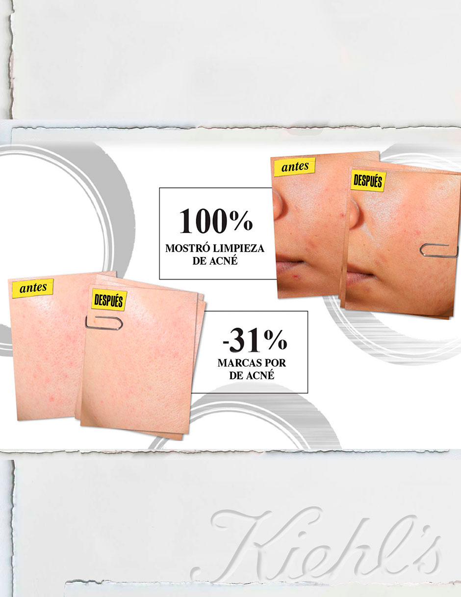 Crema facial recomendada para acné día y noche Face Expertly Clear Blemish Treating And Preventing Lotion Acné todo tipo piel 5