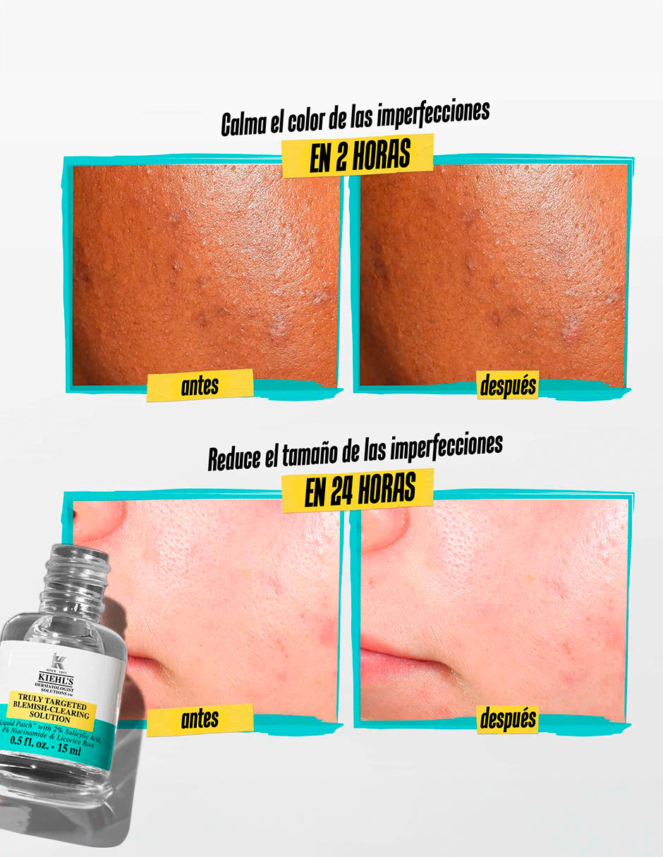 Sérum antiacné facial Truly Targeted Blemish Clearing Solution todo tipo de piel 10